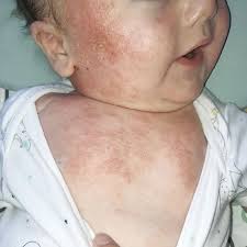 Baby's eczema so bad people thought he'd been burned cured with simple  cream