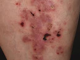 These images are a random sampling from a bing search on the term cutaneous lichen planus. Lichen Planus Atrophicans Altmeyers Encyclopedia Department Dermatology