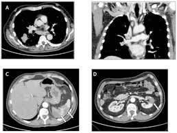 A misdiagnosis of early symptoms can significantly impact a patient's outcome and quality of life. Systemic Thromboembolism From A Misdiagnosed Non Bacterial Thrombotic Endocarditis In A Patient With Lung Cancer A Case Report