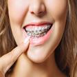 Teeth Braces product image
