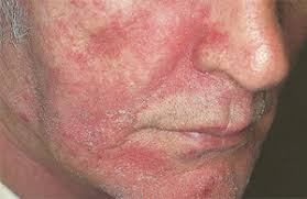 Seboreik Dermatit - Dr. Yeşim Altun | Dermatolog, Klinik Dermatoloji ve  Estetik Dermatoloji.