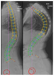 Scheuermann's kyphosis, scheuermann's disease, scheuermann kyphosis. Scheuermann S Kyphosis A 39 Year Follow Up From Diagnosis In Non Operated Patients European Spine Journal