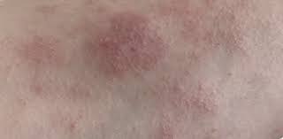 Maybe you would like to learn more about one of these? Examining The Cross Section Of Itch And Pain In Ad The Dermatologist Hmp Global