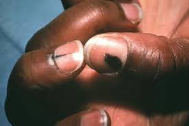 Phaeoannellomyces werneckii é um fungo marrom que é encontrado no solo, composto e na madeira (geofílico fingi). Melanoma Na Unha O Que E Sintomas E Tratamento Tua Saude