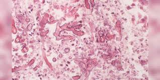 Mucormicosis.) y bien inducido, este último es. What Is Mucormycosis The Fungal Infection Affecting Covid Patients In India