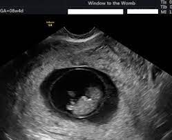 This assurance may be very important for women who are experiencing pain or bleeding in the pregnancy and those who have had previous miscarriages or ectopic pregnancies. Specialist Fertility Treatment Scans Firstscan At Window To The Womb