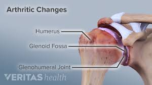 Our website is not intended to be a substitute for professional medical advice, diagnosis, or treatment. What Is Shoulder Osteoarthritis Glenohumeral Arthritis