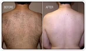 However, laser hair removal is now widely laser hair removal procedures performed in clinics and establishments that provide this service use hand held laser machines, wherein the. Laser Hair Removal Permanent Laser Hair Removal