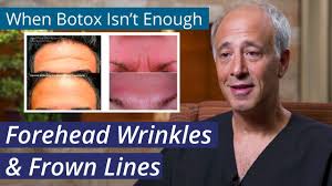 How many botox units are best for horizontal forehead lines? Treating Forehead Wrinkles How To Get Rid Of Stubborn Foreheadlines When Botox Isn T Enough Youtube