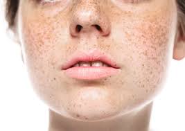 Image result for Freckled skin