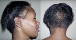 That makes it seem thicker and more luscious. 7 Ways To Grow Your Edges Back And Treat A Thinning Hairline Naturallycurly Com