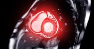 Image result for Cardiac MRI