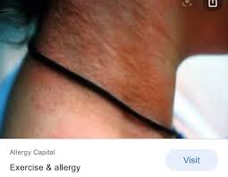 Image result for Exercise-Induced Anaphylaxis