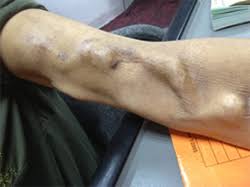 Search for arteriovenous fistula in these categories. Arteriovenous Fistula