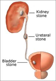 urinary stones ciplamed