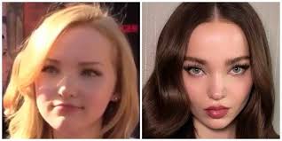 Dove Cameron Plastic Surgery: Did It Happen?