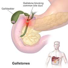 Risks and long term complications. Gallstone Wikipedia