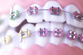 Fill your cloth container with the filling. The Dangers Of Fake Braces Diy Braces More Accorde Orthodontists
