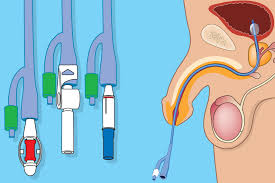 Image result for Urethral Catheterization