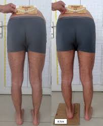 Image result for Functional Leg Length Discrepancy
