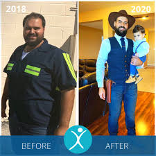 After gastric bypass, your body may be less able to tolerate refined sugars or high amounts of fats. Gastric Sleeve Before And After Photos The Best Pictures Of 2020
