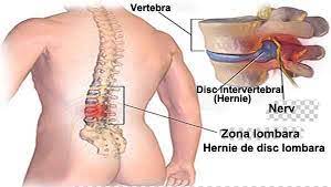 Ce este hernia de disc • factorii de risc • tipuri • stadii • diagnosticare • interventia chirurgicala • tratament. Cum Scapam De Operatie In Cazul Herniei De Disc Lombare Fizioterapie Bucuresti Kinetoterapie Bucuresti Impachetari Cu Namol Bucuresti