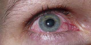 Augen Jucken Und Tranen Das Hat Es Mit Der Augengrippe Auf Sich Kolnische Rundschau