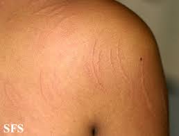 Image result for Dermatographism