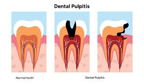 Image result for Pulpitis