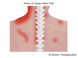 Upper border of ribs ii to v just lateral to their angles. Upper Back Muscle Strains Information Sinew Therapeutics