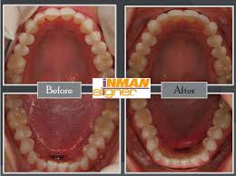 With the patented inman aligner, your front teeth can be gently guided to an ideal position in a matter of weeks. 48 Inman Aligner Bromley Ideas Inman Inman Aligner Alignment
