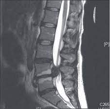 Cauda Equina Syndrome From Lumbar Disc Herniation Cauda Equina Cauda Equina Syndrome Magnetic Resonance Imaging