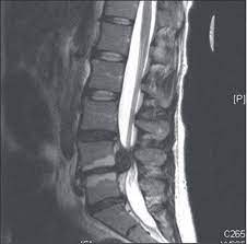 Check spelling or type a new query. Cauda Equina Syndrome From Lumbar Disc Herniation Cauda Equina Cauda Equina Syndrome Lumbar Disc
