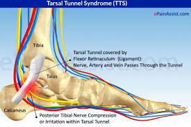 Tarsal Tunnel Syndrome Podiatrist In Torrance Los Angeles San Pedro Ca Precision Foot And Ankle Centers