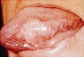 Image result for white cancer on tongue)