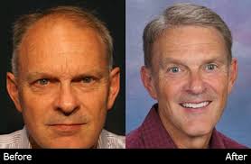 Meet Mark DiStefano and Chris Heinis of DiStefano Hair Restoration Center