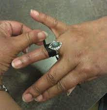 My Finger Is Swollen And Now I Can T Get My Ring Off Rings Bone And Joint Patient Education