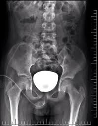 This video contains information that everyone should know about the voiding cystourethrogram (vcug) procedure. Voiding Cystourethrography Radiology Reference Article Radiopaedia Org