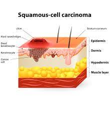 Of course, your specialist is the main person whose advice you should follow but it doesn't do anyone harm. Types Of Skin Cancer Different Types Treatments Columbia Skin