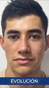 El viaje de Edwin 🛩️10 días hacia su nueva apariencia y una mejor forma de  respirar 🌬️, Cada día cuenta en el proceso de transformación 😎 Edwin  comenzó su recuperación con paciencia, confianza y mucha ...