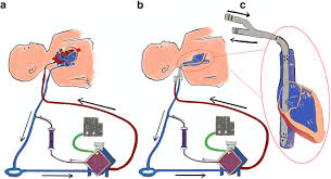 Искать «экмо аппарат цена» в яндексе. Neonatal Respiratory And Cardiac Ecmo In Europe Springerlink