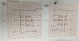 Hess Chart Hess Chart Showed Under Action Of The Left And