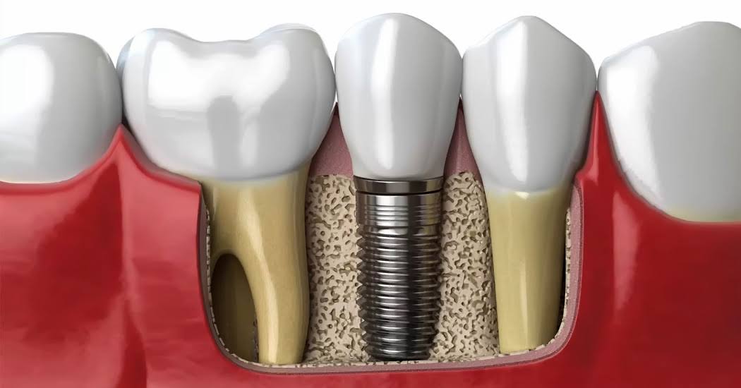 dental implant product image