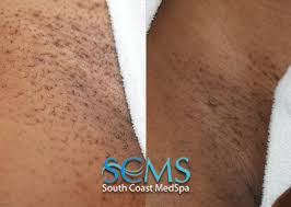 The issue is that only 20% of all body hair is in this particular phase at any point in time. Bikini Line Laser Hair Removal Results Shown After 3 Tre Flickr
