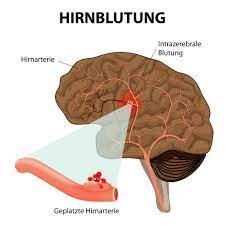 Hirnblutungen Entstehung Symptome Therapie