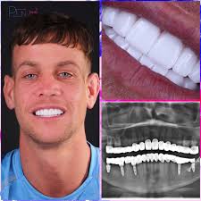 Today, we will share Christopher's story from Manchester to Antalya. We  can't get enough of Chris' endless energy, kindness and fun. We hope your  new smile brings more energy, kindness and happiness.