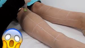 Red patches on day 3 of laser hair removal with cynosure, anyone experienced the same thing? Getting Laser Hair Removal On My Legs Did It Hurt Youtube