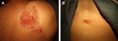 Image result for Dermatofibrosarcoma Protuberans
