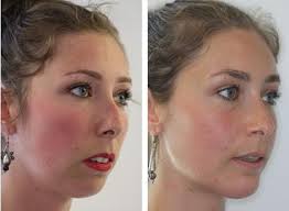 Jaw Shaping Clinics in Tijuana