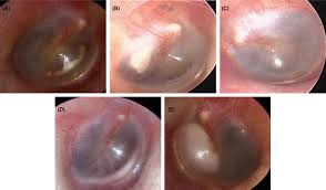 Image result for Myringosclerosis